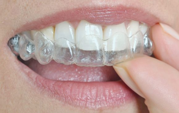 Bruksizm, Diş Gıcırdatma Nedir?