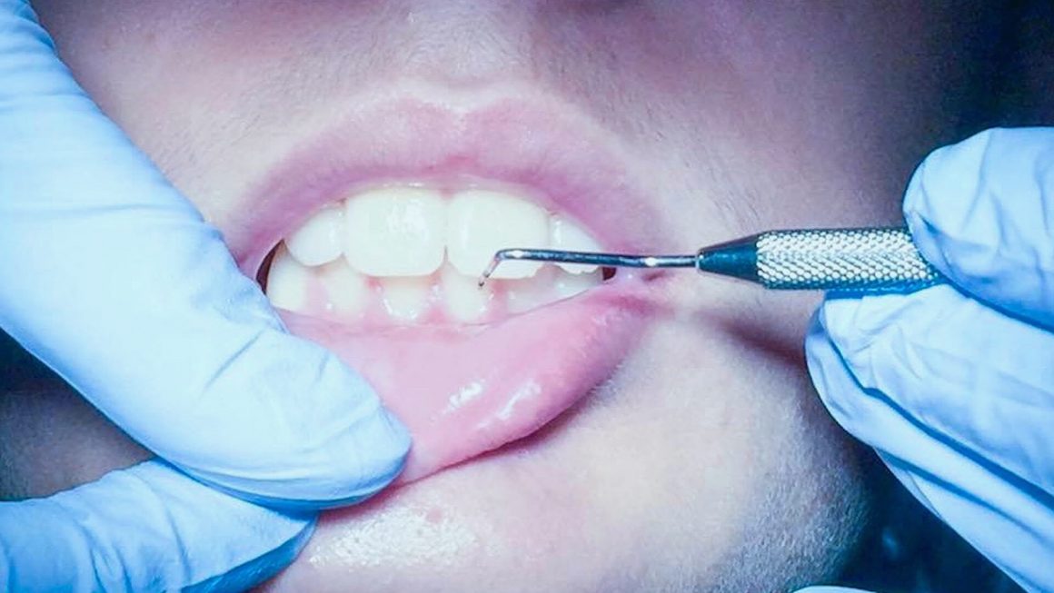 Diştaşı, Tartar Nedir? Dişeti Tedavisi Nasıl Gerçekleştirilir?