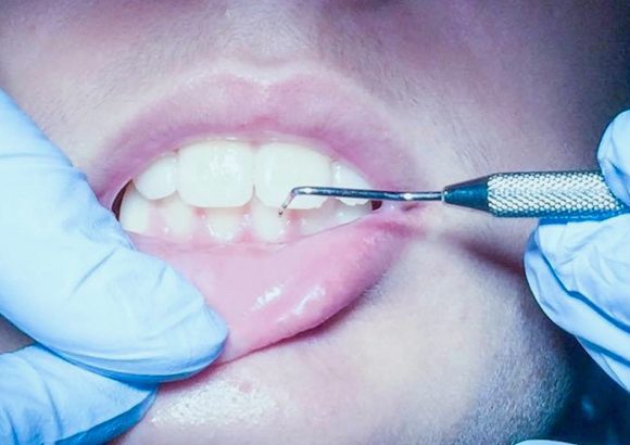 Diştaşı, Tartar Nedir? Dişeti Tedavisi Nasıl Gerçekleştirilir?